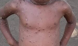 Tshopo/urgence sanitaire à Basoko : 5 décès liés au M-pox et au choléra en moins d’un mois