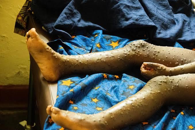 MPOX à Kaziba : La société civile tire la sonnette d’alarme et exige une riposte sanitaire urgente